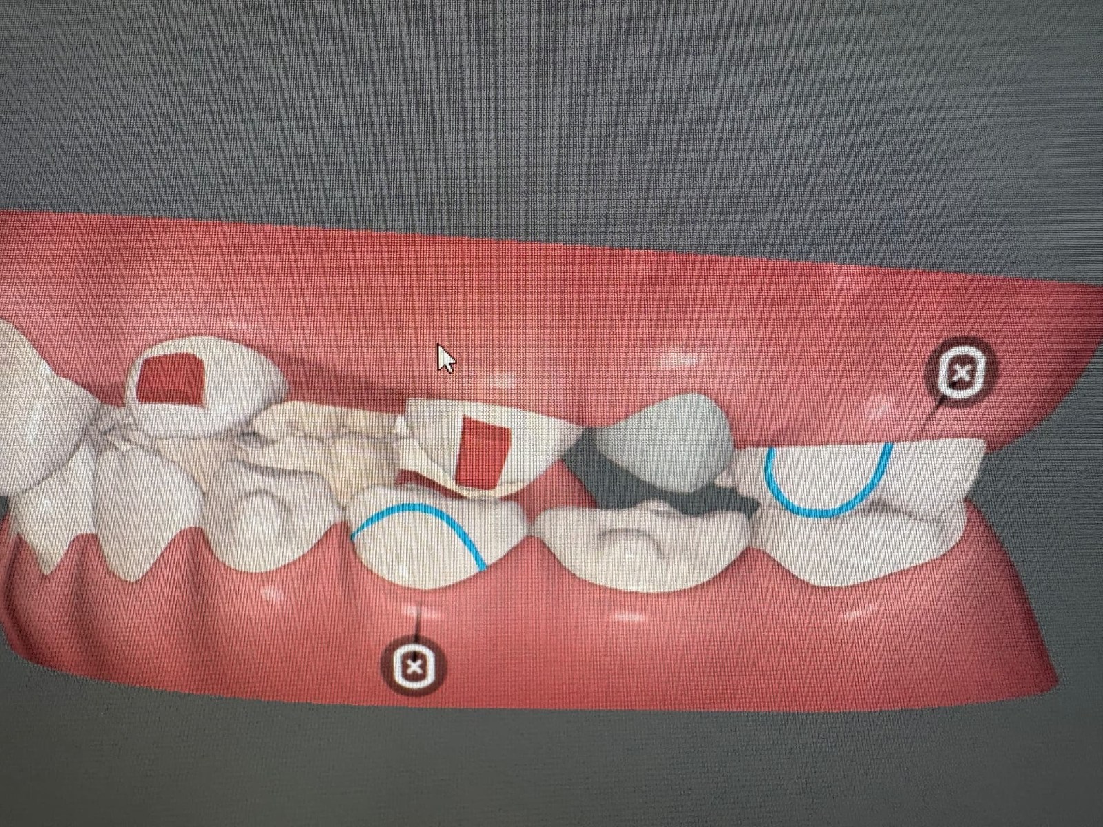 Digital tooth and bite model used for orthodontic planning