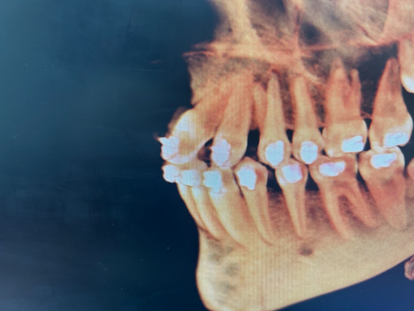 Three-dimensional jaw scan showing teeth and orthodontic appliances