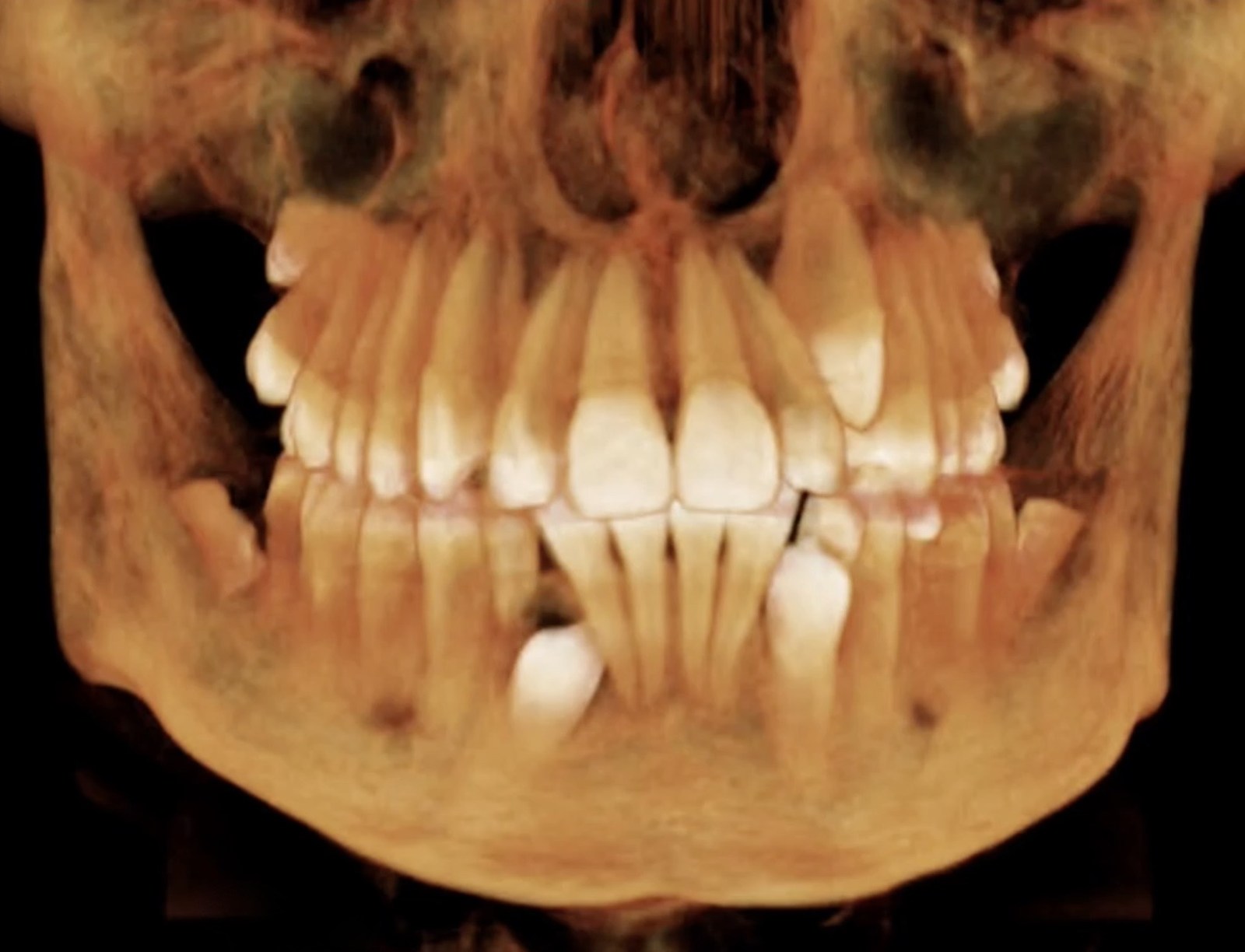 CBCT model showing the teeth and jaw
