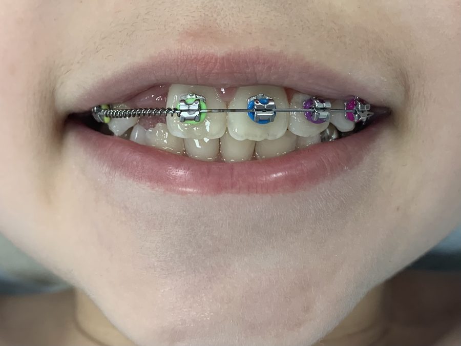 NA Orthodontics patient smiling with braces